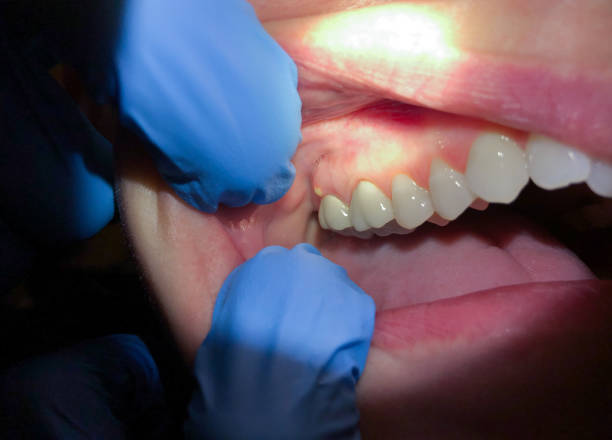Best Emergency Dental Care for Abscessed Tooth in Marion, PA